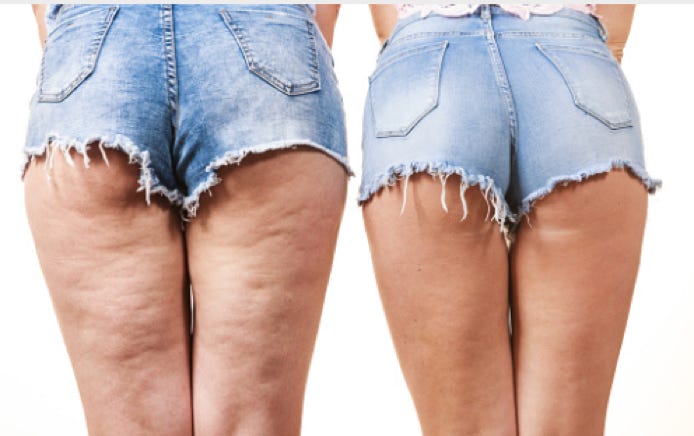Afbeelding celluitis